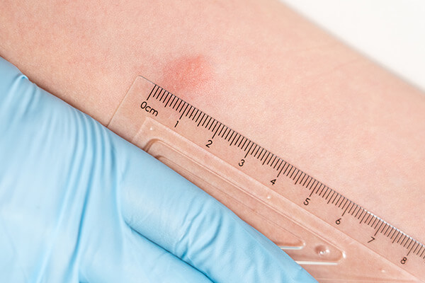 PPD Skin Test Mobile Health Professional Boston PPD Skin Test Mobile Health Professional Boston