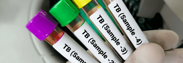 TB Testing Made Easy with Mobile Health | Employee TB Testing