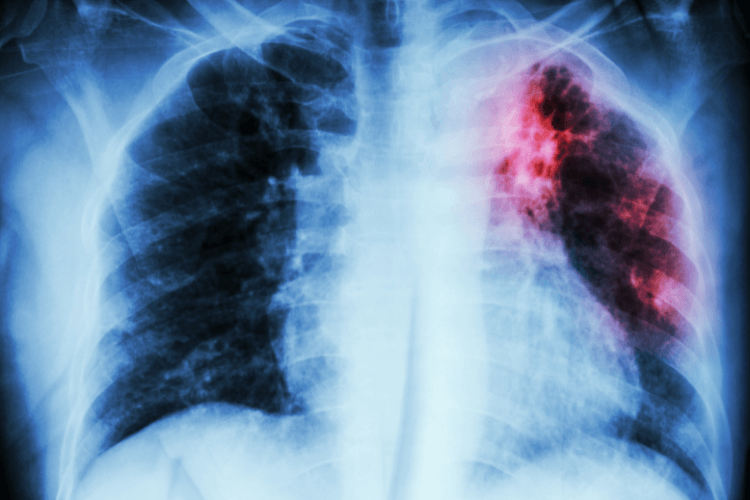 Employee Tuberculosis Testing | Mobile Health | Employee TB Testing | Occupational Health Services