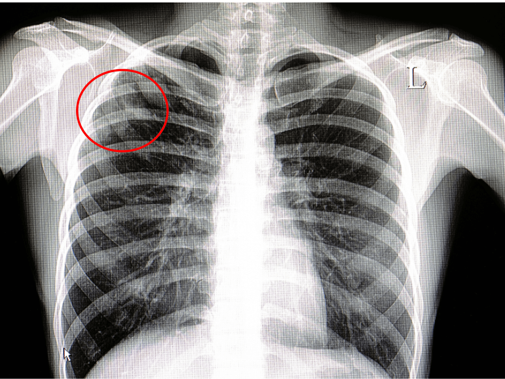 Patient TB Testing